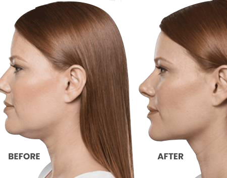 Before & After of chin with Kybella treatments