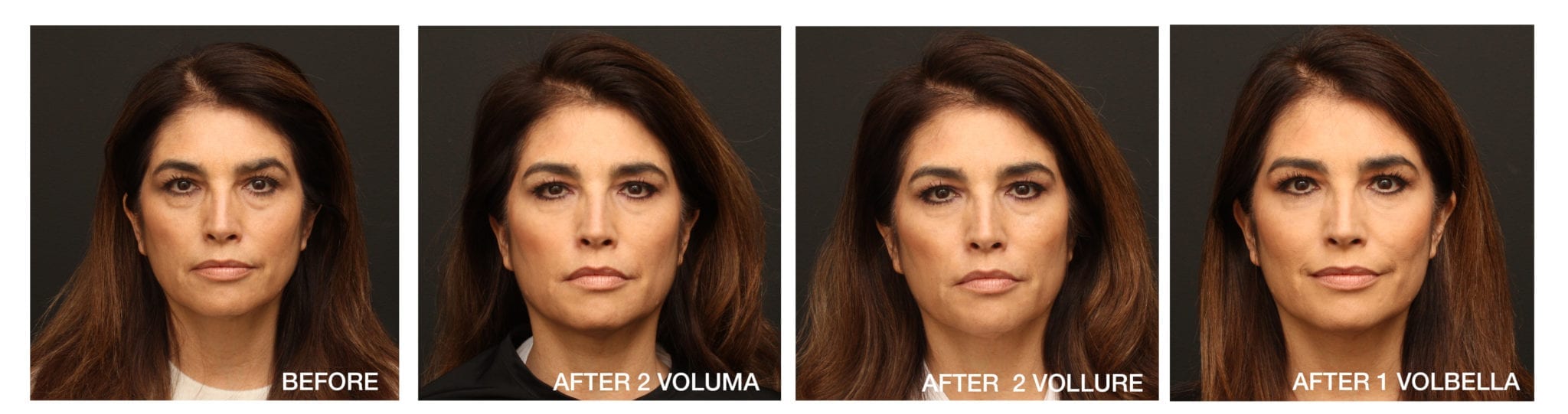 Progression on face during Juvéderm treatments