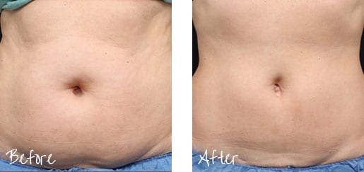 Before & After of abdomen with coolsculpting treatments