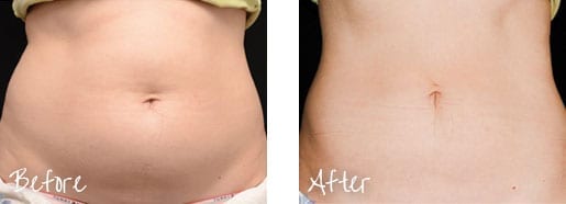 Before & After of abdomen with cosmetic treatments
