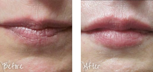 Before & After of lips with Juvéderm