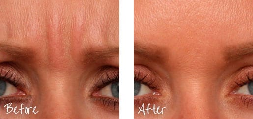 Before & After of brow with Botox treatments