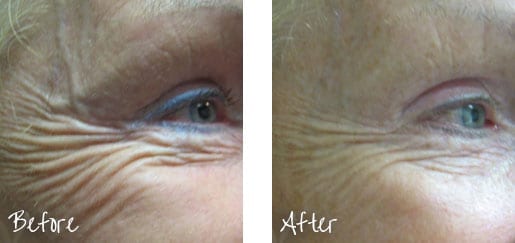 Before & After of eyes following cosmetic treatments