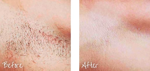 Results Of Laser Hair Removal On a Woman’s Underarms