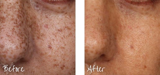 Before & After on skin on cheek with cosmetic treatments