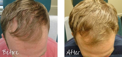 Before And After Hair Restoration Treatment Image 1