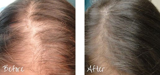 Before And After Hair Restoration Treatment Image 2