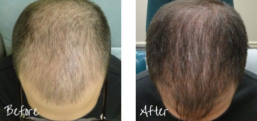 Before And After Hair Restoration Treatment Image 3