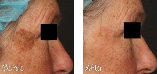 Before & After of face with intense pulsed lights treatments