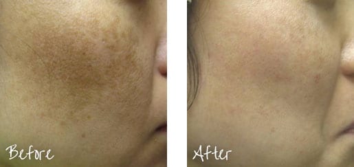 Before & After of cheek with intense pulsed lights treatments