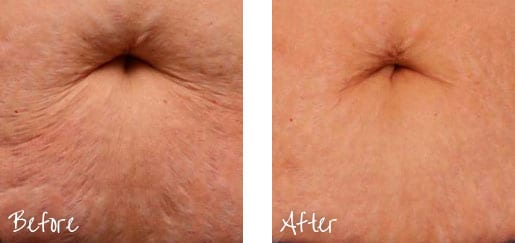 Before & After of navel with cosmetic treatments