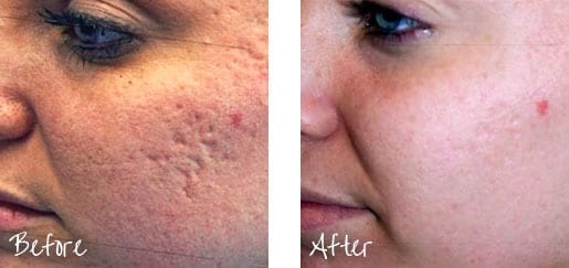 You don’t have to live with embarrassing scars and stretch marks forever.