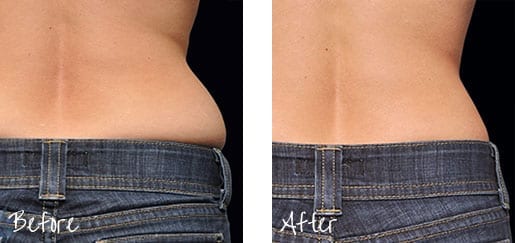Before & After of back waist with cosmetic treatments