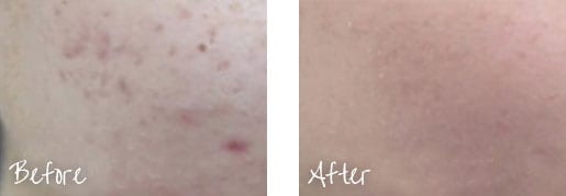 Before & After of skin following dermapen treatments