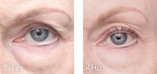 Before & After of skin around eye following Ultherapy treatments