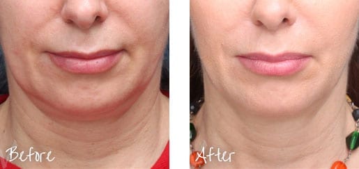 Before & After of face with Ultherapy treatments