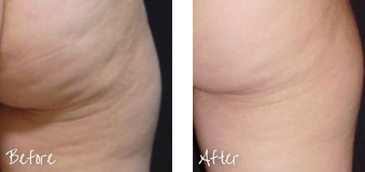 Before & After of back of leg following cellulite treatment