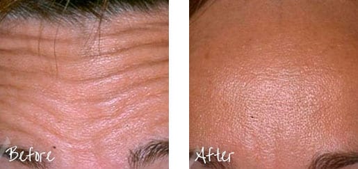 Before & After of forehead with Botox treatments