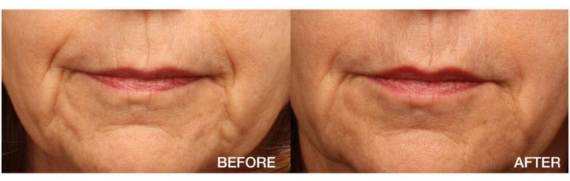 Before & After of mouth with Juvéderm