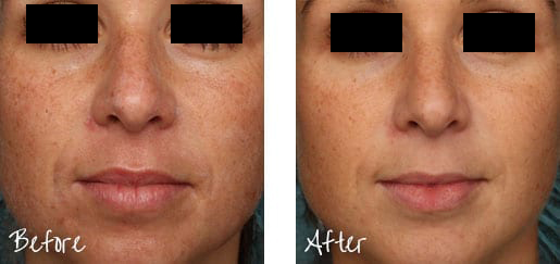 Soft, smooth skin is possible with Pixel® Laser resurfacing.