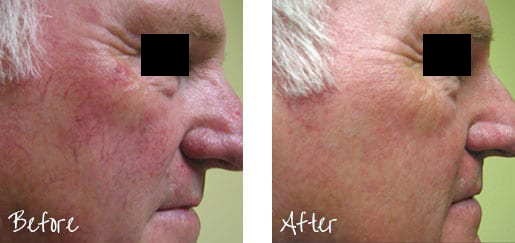 Before & After of facial blemish with intense pulsed lights treatments